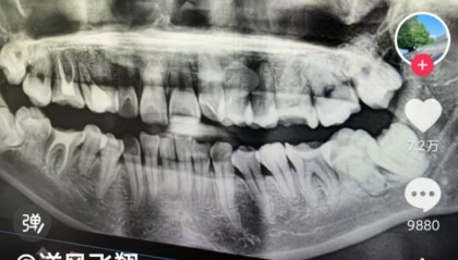 安徽一女子被拔错牙后坠楼身亡，家属：好牙位置没打麻药，硬生生拔下来