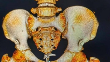 12岁男孩下体插着电线就诊!医生:这些尿道异物要注意